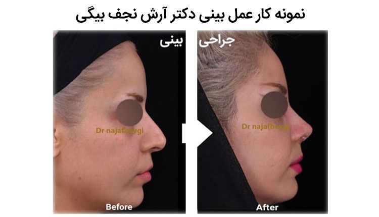 نمونه هایی از جراحی بینی توسط دکتر آرش نجف بیگا