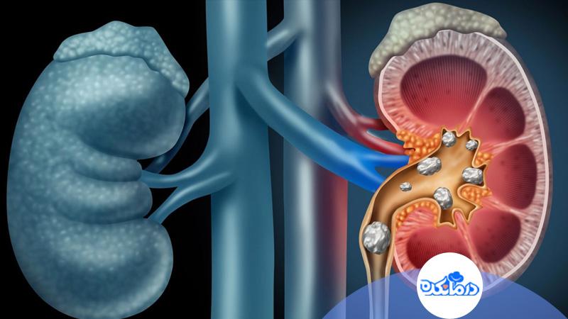 سنگ کلیه | کودک