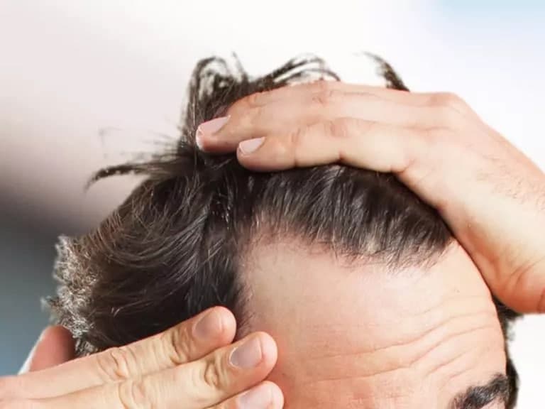 درمان ریزش مو بعد از بیهوشی