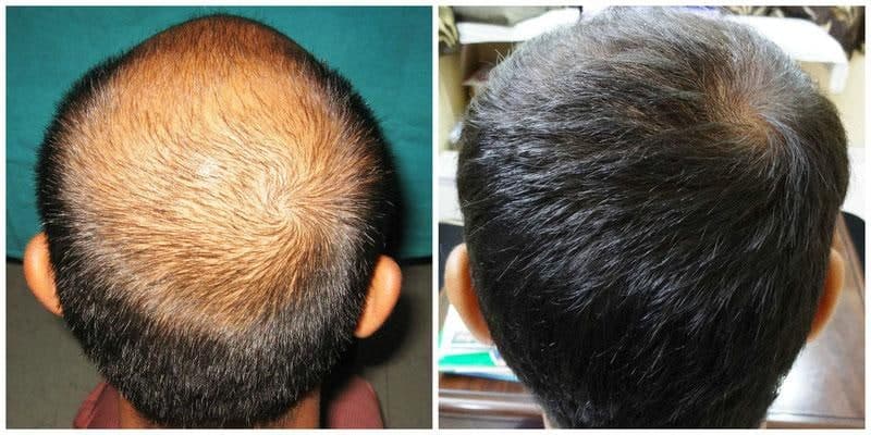 انواع روش های کاشت مو | انواع روشهای کاشت مو در ایران | بهترین روش کاشت مو با تراکم بالا