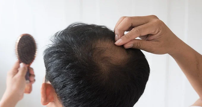 Die mees effektiewe metode om haarverlies by mans te behandel