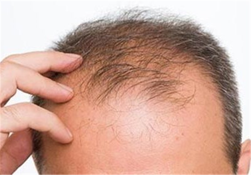 Hair loss treatment with 5 effective and excellent methods