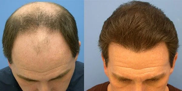 How long are the results of hair mesotherapy