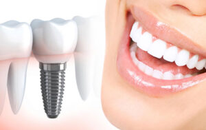 How to care for front dental implants