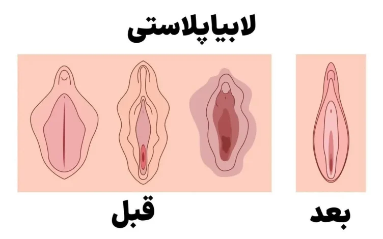 اپل