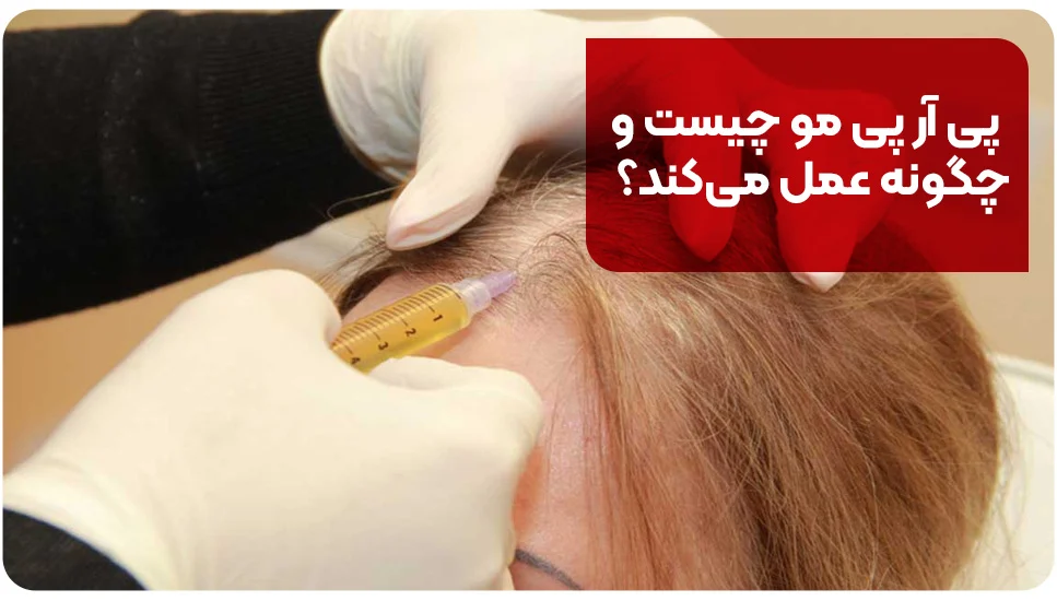 پی آر پی مو چیست و چگونه عمل می&zwnj;کند؟
