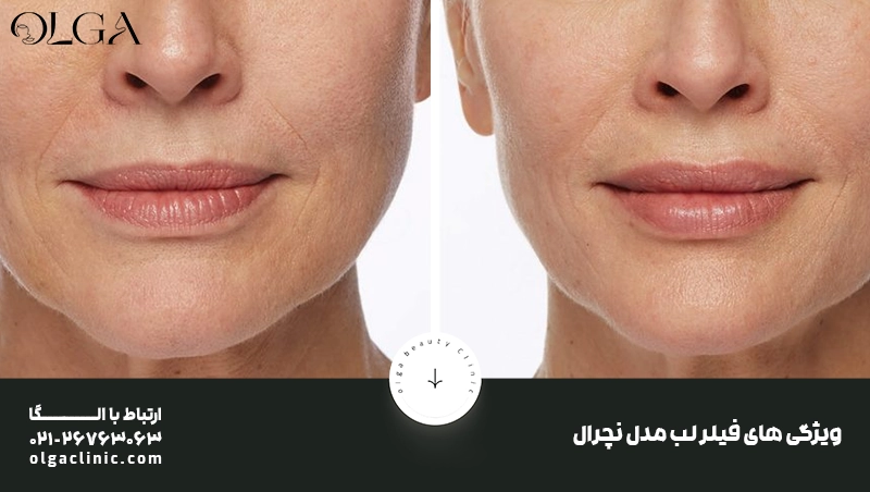 ویژگی های فیلر لب مدل نچرال